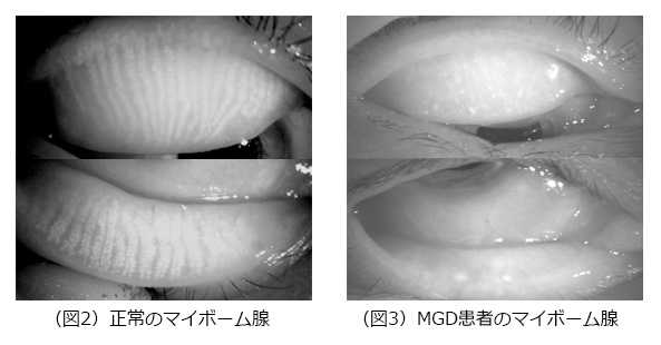 正常のマイボーム線とMGD患者のマイボーム線