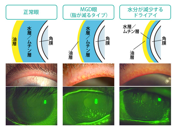 正常眼・MGD眼・ドライアイの比較